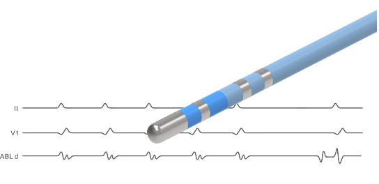 锦江电子一次性使用心脏射频消融导管