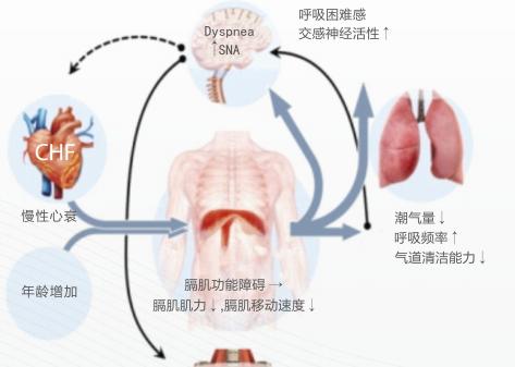 体外隔肌起搏器