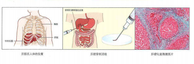 超声肝硬化