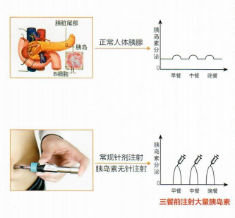 丹纳胰岛素泵