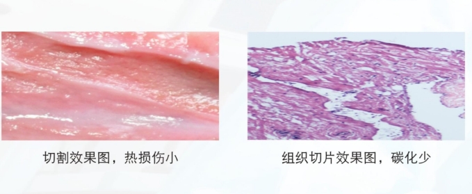 双极等离子高频手术设备